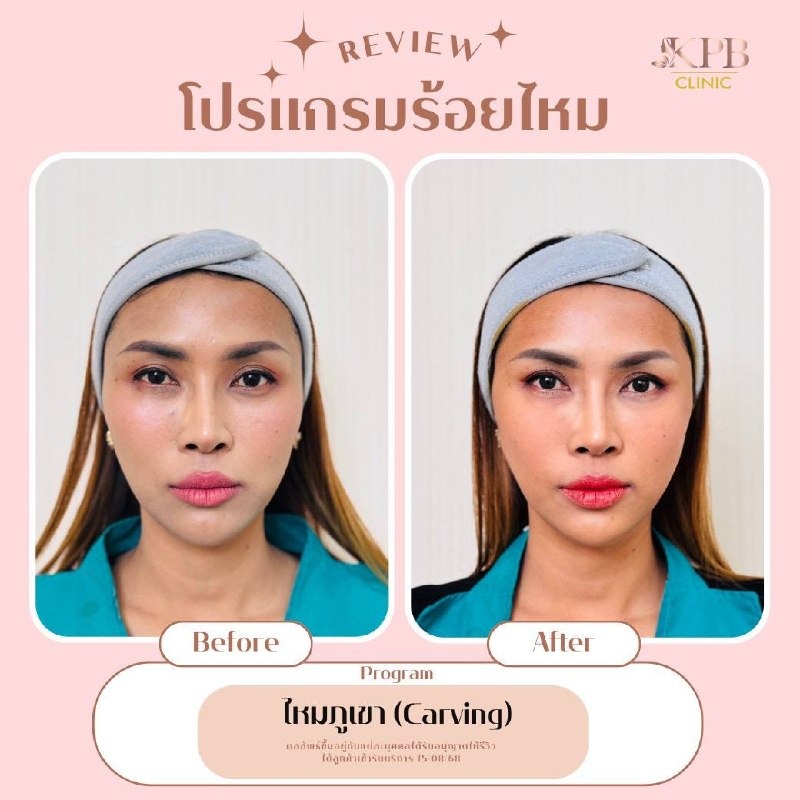 รีวิวโปรแกรมร้อยไหมโหงวเฮ้ง KPB Clinic