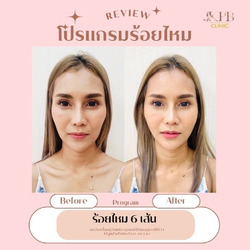 รีวิวโปรแกรมร้อยไหม KPB Clinic ลำดับที่ 2
