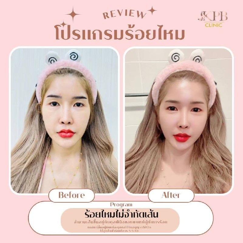 รีวิวโปรแกรมร้อยไหม KPB Clinic ลำดับที่ 3