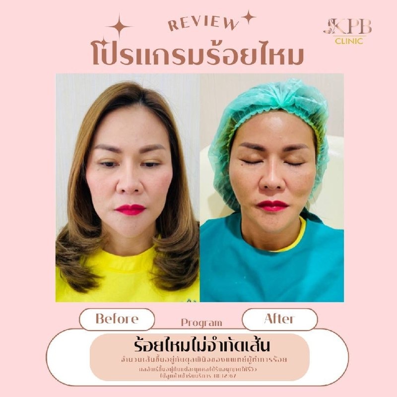 รีวิวโปรแกรมร้อยไหม KPB Clinic ลำดับที่ 4