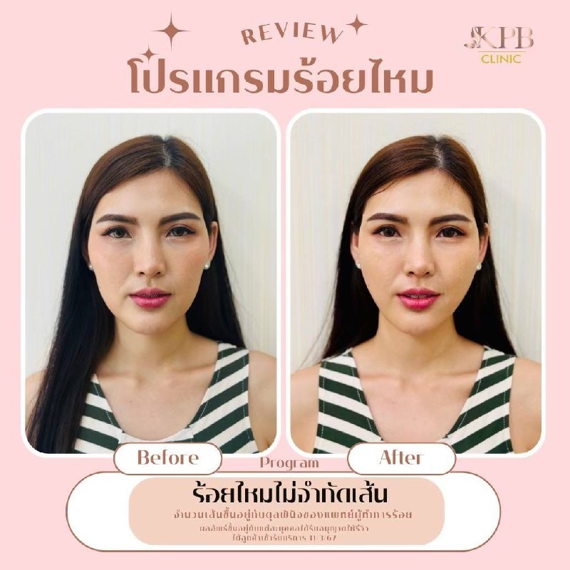 รีวิวโปรแกรมร้อยไหม KPB Clinic ลำดับที่ 5